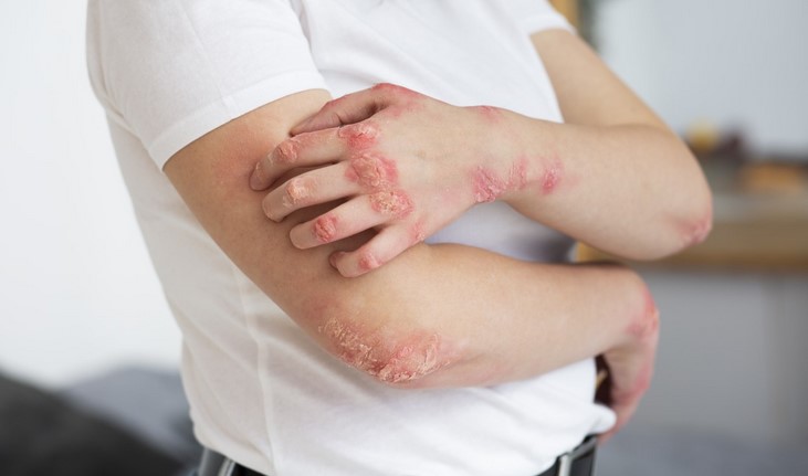 Salud reporta primer paciente fallecido diagnosticado con Mpox Salud reporta primer paciente fallecido diagnosticado con Mpox